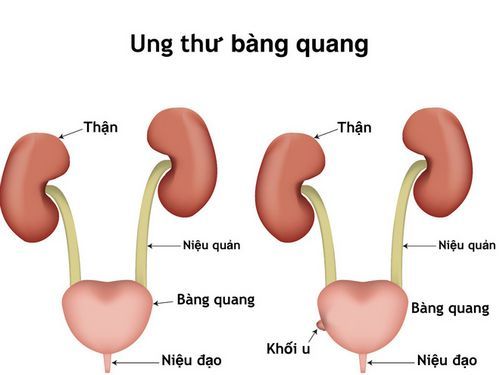 Bladder cancer - Hình ảnh minh họa